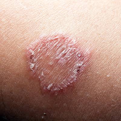 Why Is My Tinea Not Going Away Australia