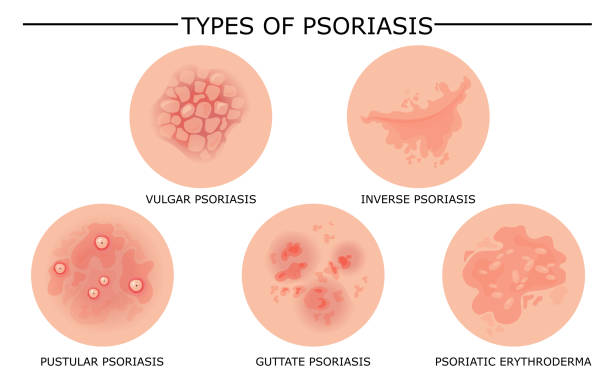 Types of Psoriasis Australia