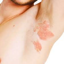 Eczema on Armpits Australia