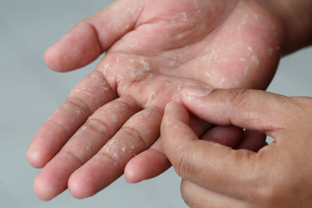 Urea for Eczema Australia