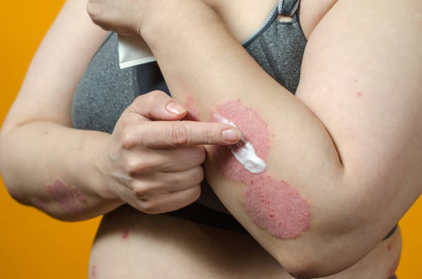 Urea Cream for Psoriasis Australia