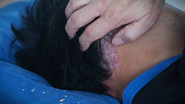 UVB Light Therapy for Scalp Psoriasis