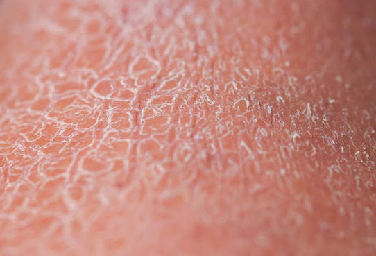 Very Dry Skin Australia