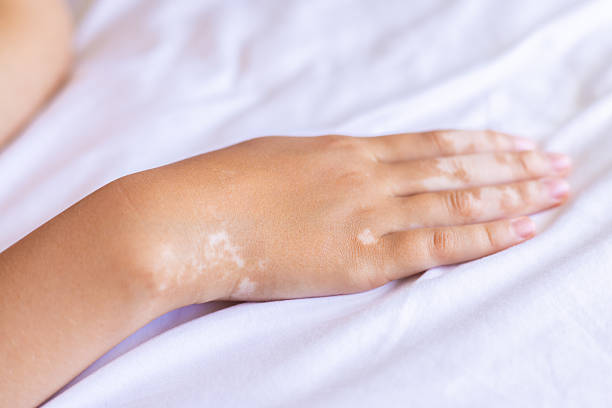 UVB Light Therapy for Vitiligo