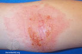 Weeping Eczema Australia