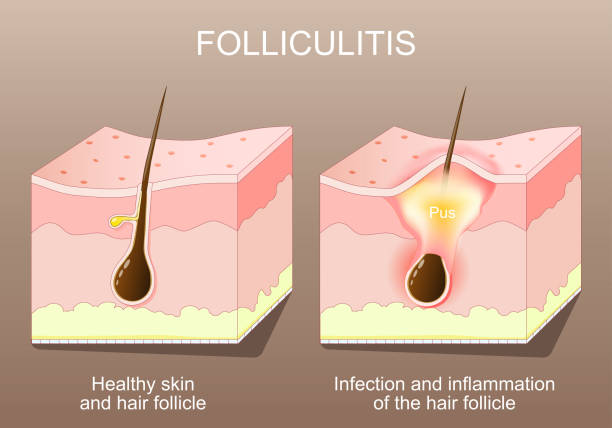 What Shampoo for Folliculitis