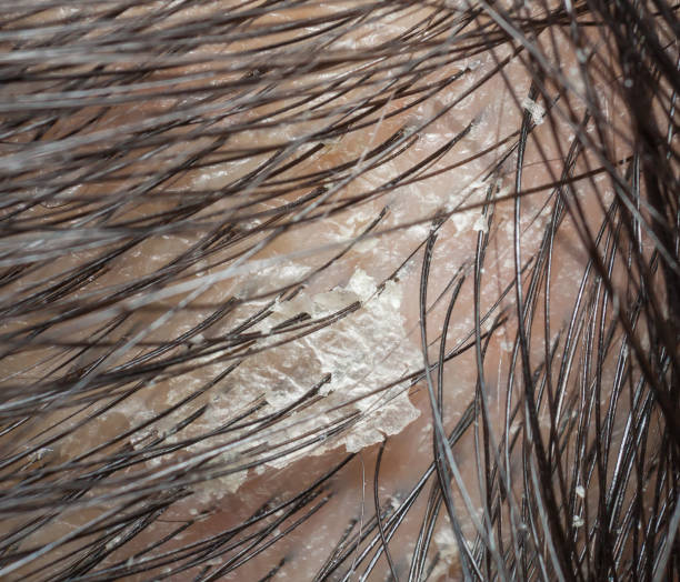 where to buy uvb lamp for scalp psoriasis