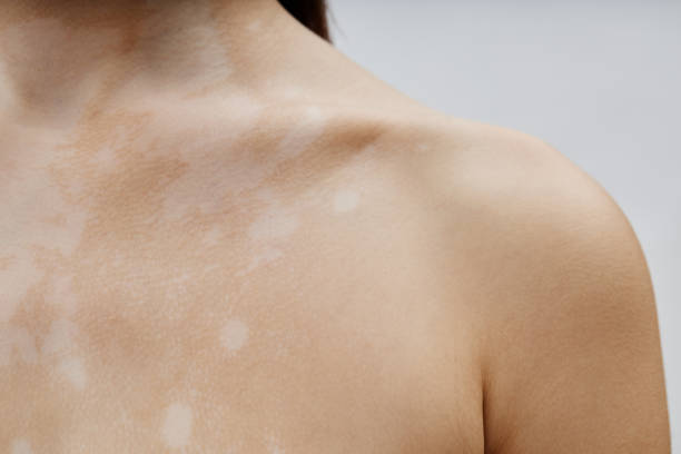 White Patches on Skin Australia