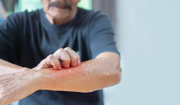 Why Does Eczema Itch