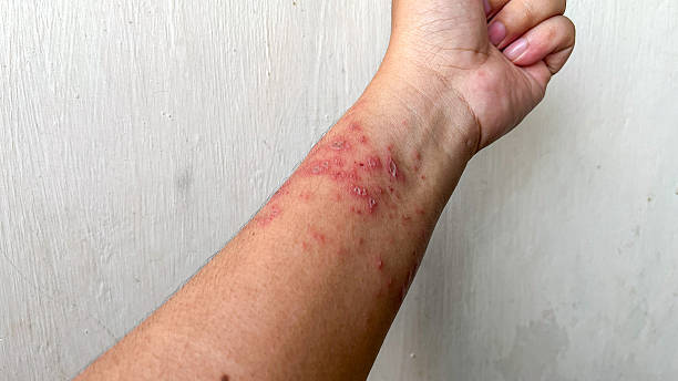 Psoriasis on Wrists Australia