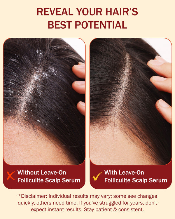 Folliculite Daily Scalp Rescue Serum