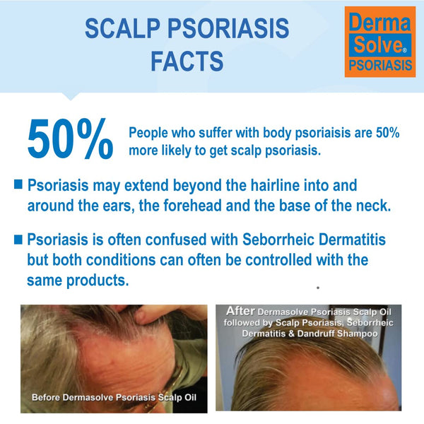 Scalp Psoriasis Facts