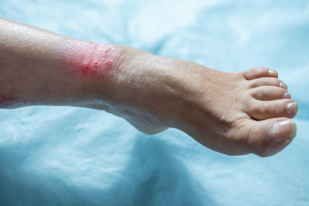 Eczema Flare Up Relief