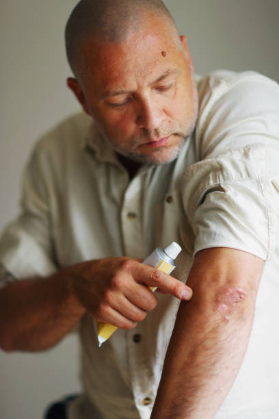 Psoriasis Cream