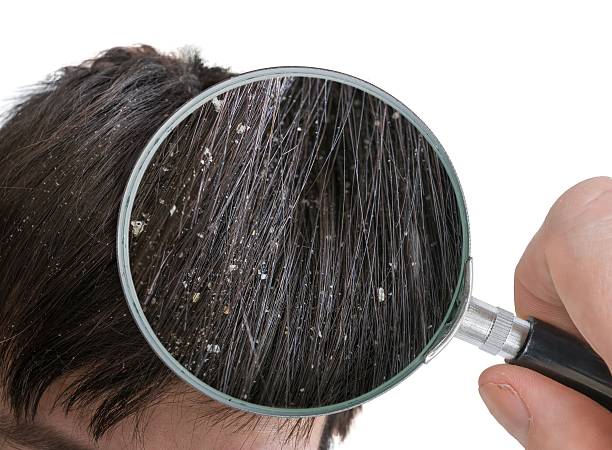 How to Use Coal Tar Shampoo for Psoriasis