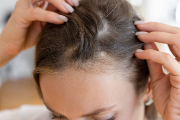 Coal Tar Shampoo vs Ketoconazole