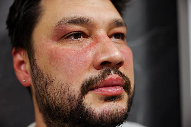 Dermatitis on Face vs Eczema