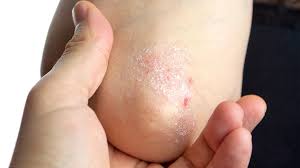 Psoriasis Flare Ups