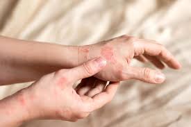 Eczema