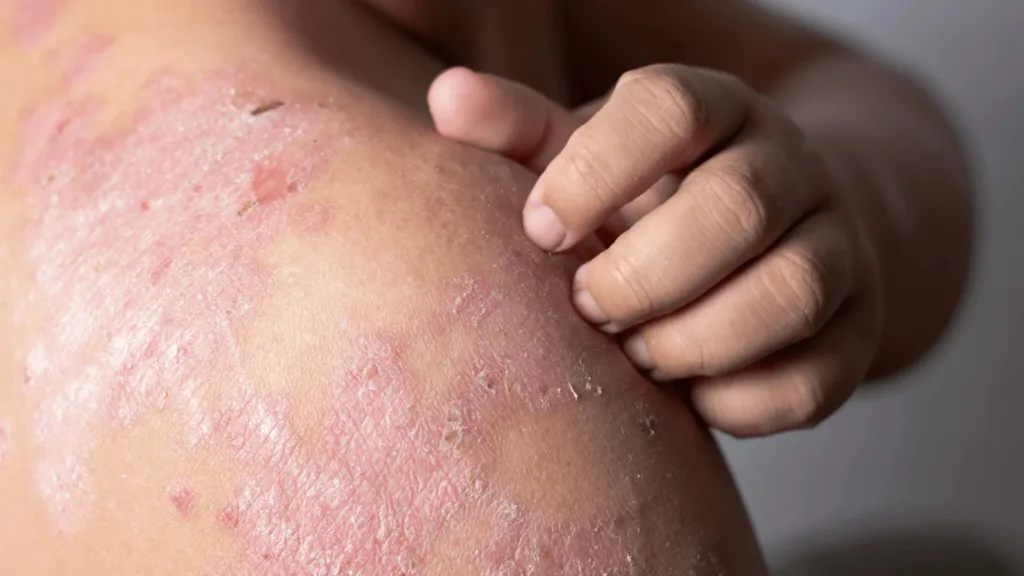 Is Eczema Curable Australia?
