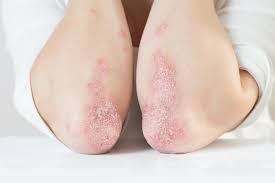 Psoriasis Flare Ups