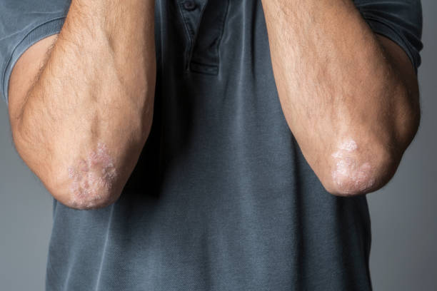 Psoriasis Cream for Elbows