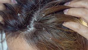 Best Shampoo for Seborrheic Dermatitis Australia